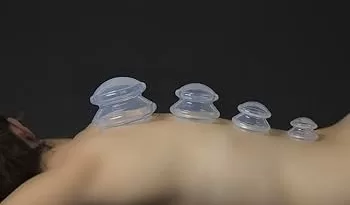 cupping treatment to person's back