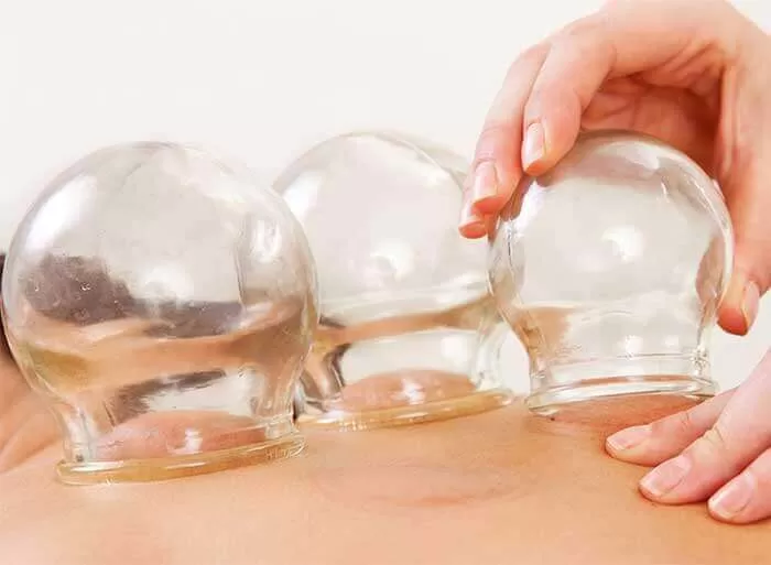 cupping treatment